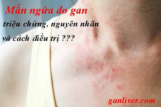 Mẩn ngứa do gan: Nguyên nhân và cách điều trị. Xem ngay!